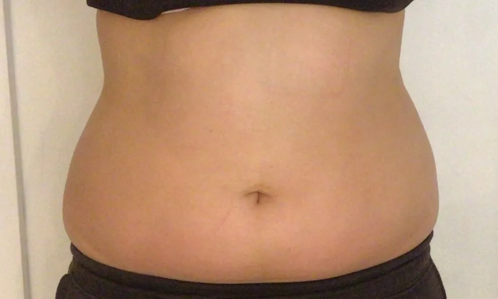 Before body contouring at Laserlite Aesthetic Clinic, front view Before body contouring at Laserlite Aesthetic Clinic, front view