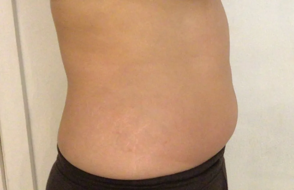 After body contouring at Laserlite Aesthetic Clinic, side view After body contouring at Laserlite Aesthetic Clinic, side view