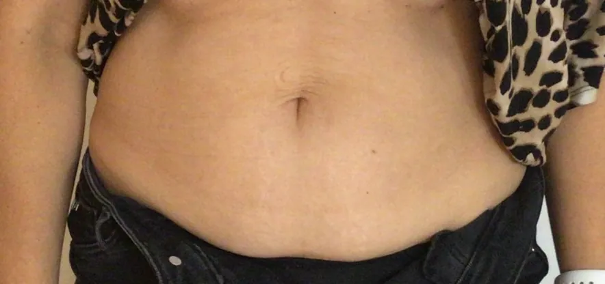 Before body contouring at Laserlite Aesthetic Clinic, front view Before body contouring at Laserlite Aesthetic Clinic, front view