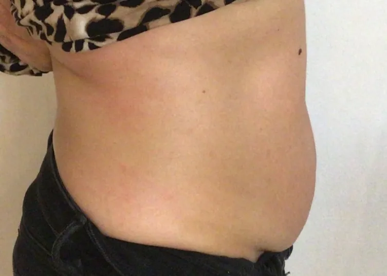 After body contouring at Laserlite Aesthetic Clinic, side view After body contouring at Laserlite Aesthetic Clinic, side view