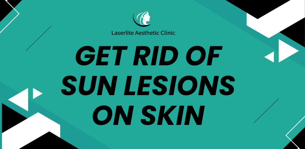Get rid of sun lesions on skin